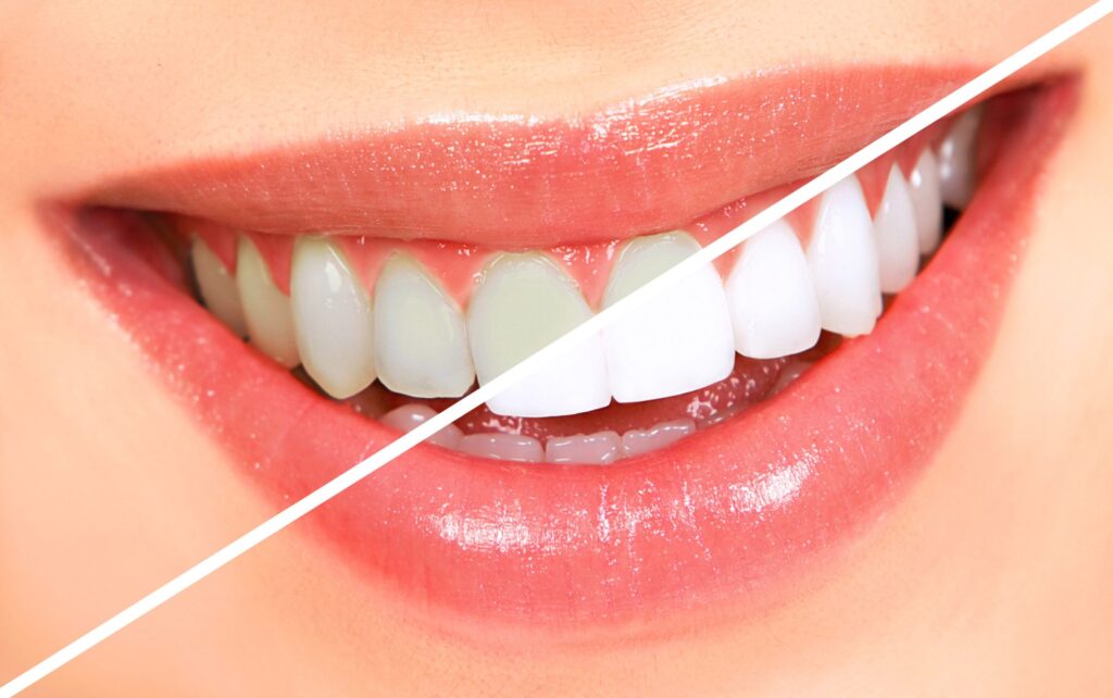What To Look For A Professional Teeth Whitening Dentist